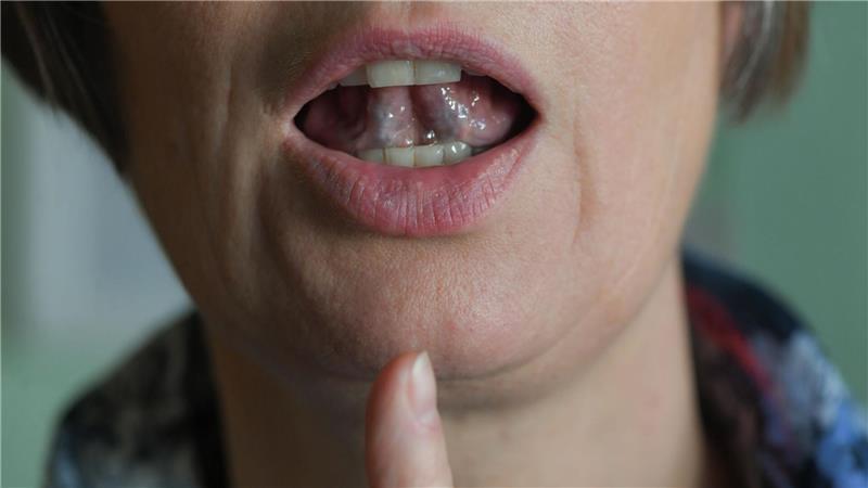 Was Stottern ist und wie Betroffene damit umgehen können Stotternde Menschen können mit Hilfe von regelmäßigen Sprechübungen ihren Redefluss verbessern. (Symbolbild)