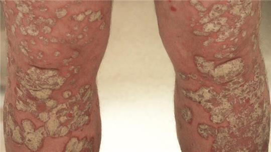 Wie ein zufriedenes Leben mit Psoriasis heute gelingen kann Weltweit sind schätzungsweise 125 Millionen Menschen an Psoriasis und Psoriasis-Arthritis erkrankt. Sie zählt neben Neurodermitis zu den häufigsten Hauterkrankungen überhaupt und ist nicht ansteckend.