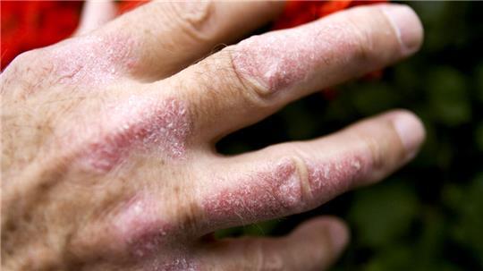 Wie ein zufriedenes Leben mit Psoriasis heute gelingen kann Weltweit sind schätzungsweise 125 Millionen Menschen an Psoriasis und Psoriasis-Arthritis erkrankt.